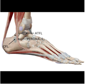 Lateral Ankle sprain